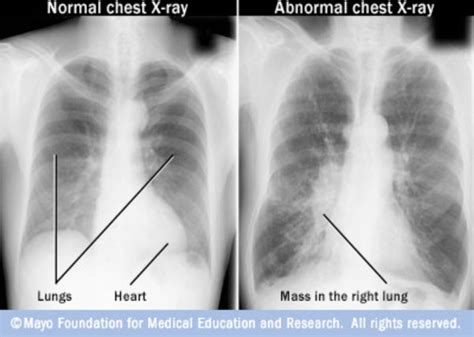 Lung Cancer Vs Normal Chest X Ray Pathology Of Copd