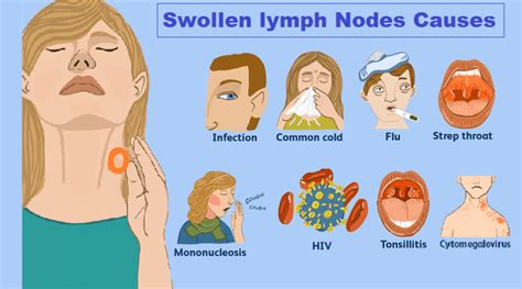 Lymph Nodes Guide: Causes And Treatment Options