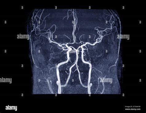 Magnetic Resonance Angiography Mra Of The Brain Showing Findings Of