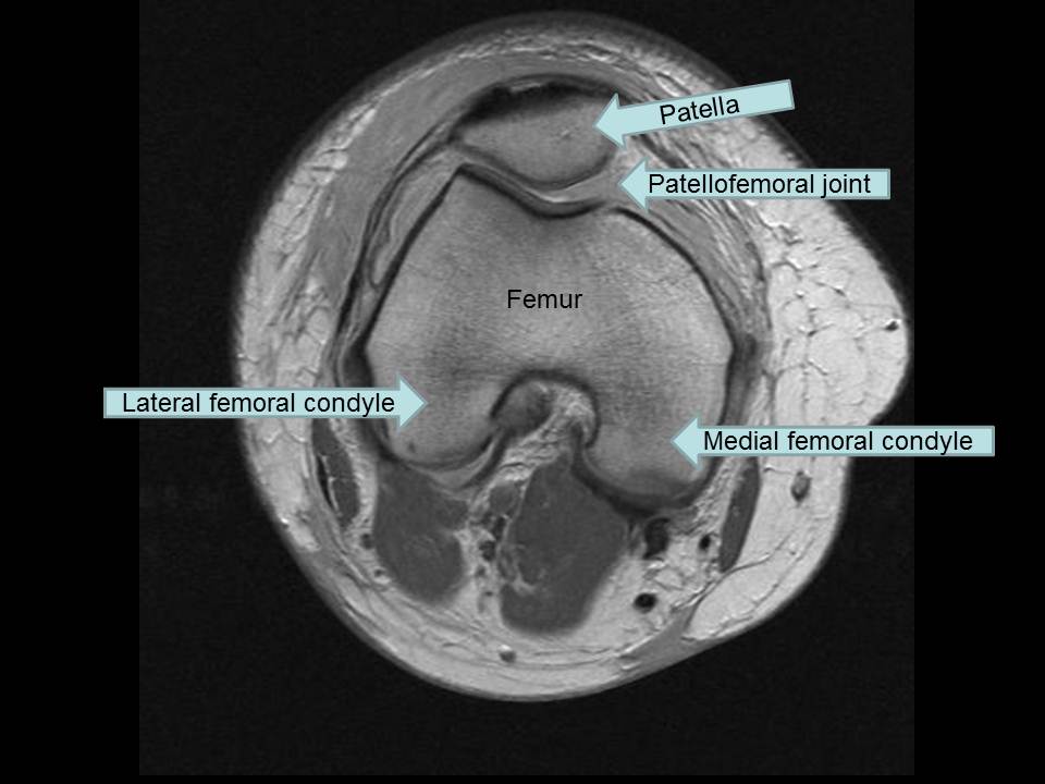 Magnetic Resonance Imaging Knee