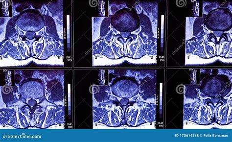 Magnetic Resonance Imaging Of A Patient Spine With Chronic Back Pain