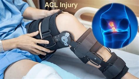 Management Of Acl Injury Xphysiotherapy