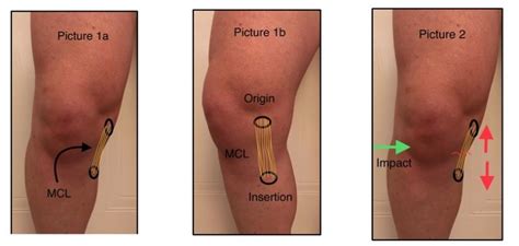 Mcl Sprain Recovery Silver Nexus