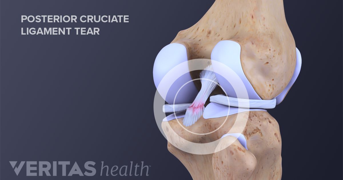 Medial Cruciate Ligament Exercises: Reduce Pain