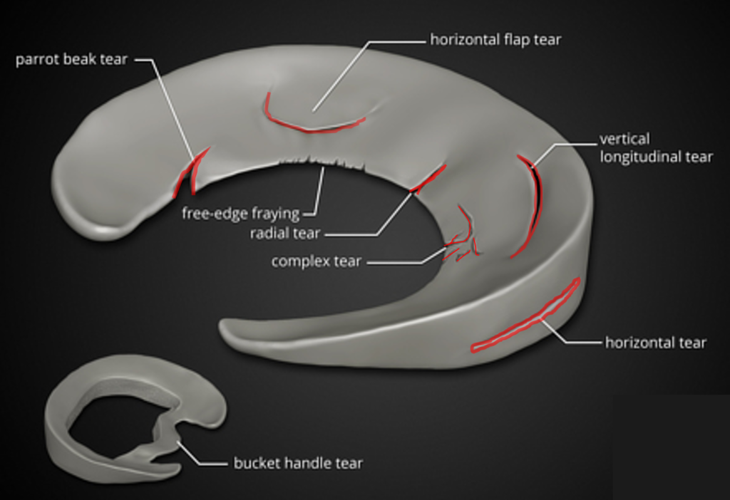 Meniscus Operation Recovery