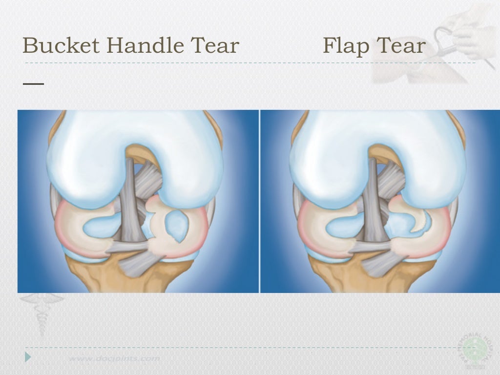 Meniscus Repair Surgery Meniscectomy Vs Meniscus Repair