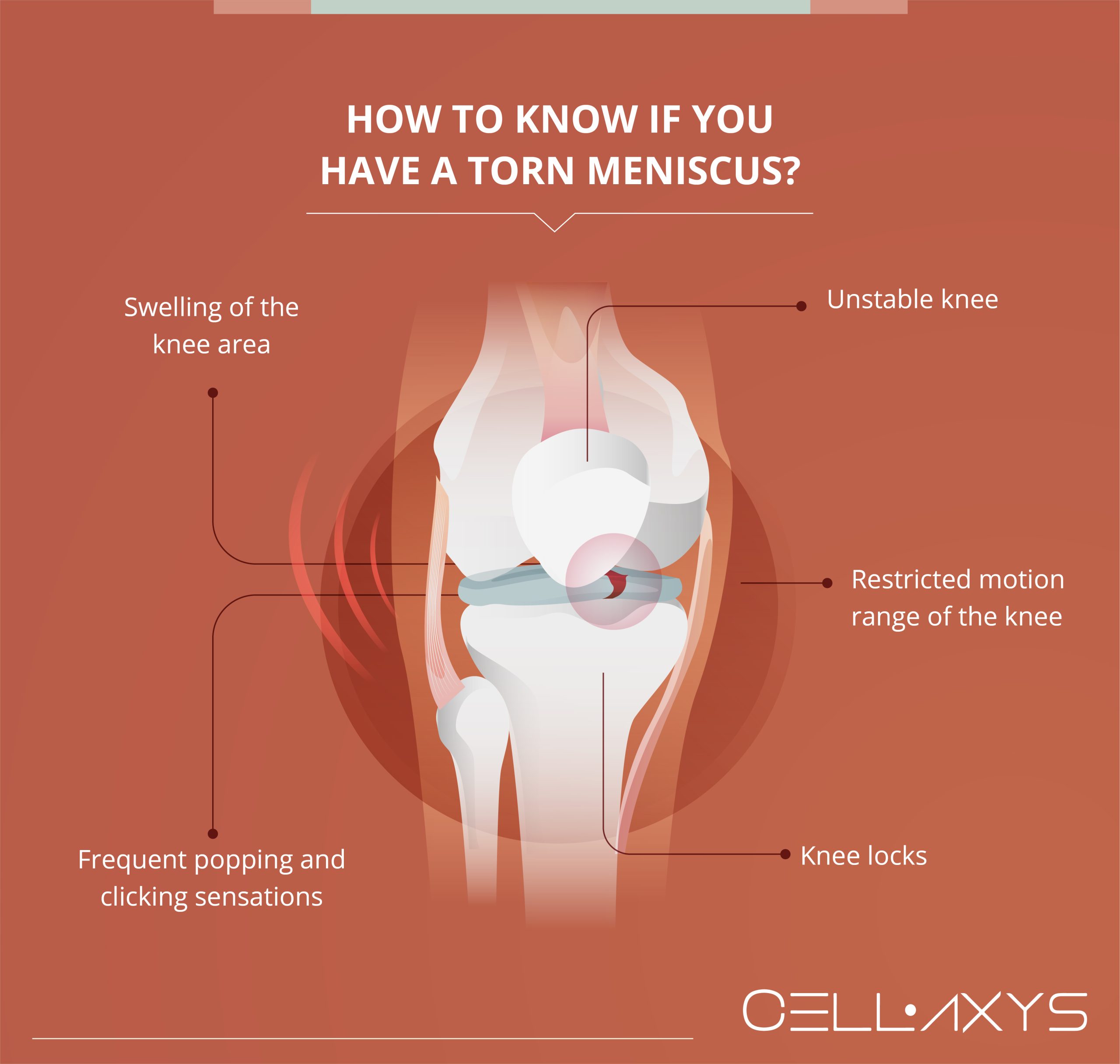 Meniscus Rupture Rehab: Heal Faster