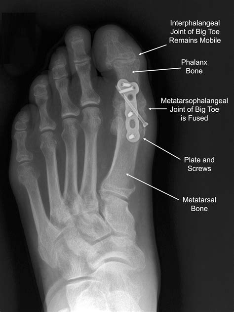 Metatarsal Bone Spur Treatment