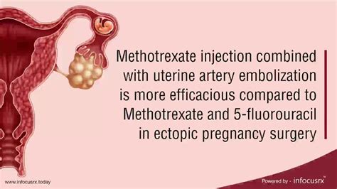 Methotrexate Injection For Ectopic Pregnancy