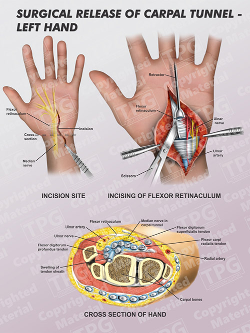 Mini Open Carpal Tunnel Release Surgery