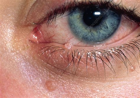 Molluscum Warts In Eyelid