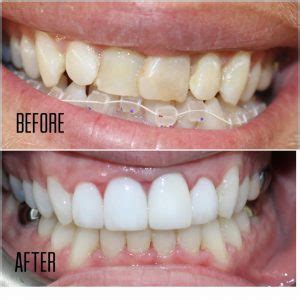 Mothlhtqqjbpqdp Invisalign Before And After Crooked Teeth