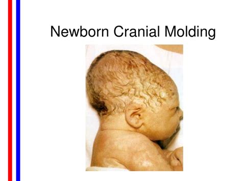 Moulding In Newborn