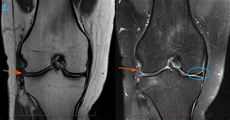 Mri For Knee: Injury Detection Made Easy