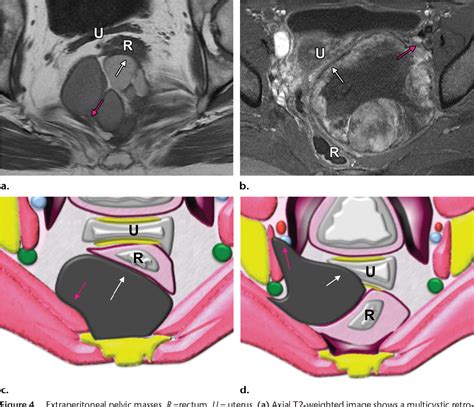 Mri Of Tumors And Tumor Mimics In The Female Pelvis Anatomic Pelvic