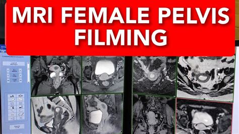 Mri Pelvis Guide: Comprehensive Female Scan