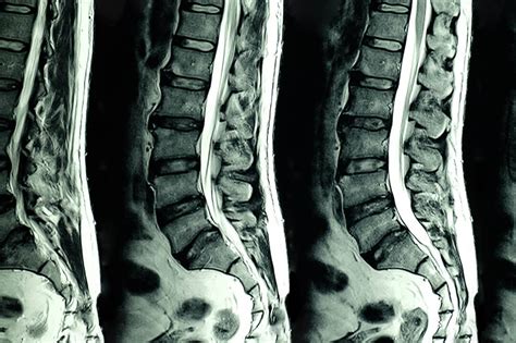 Mri Scan Of Lumbar Spines Imaging Important For Back Pain Rebalance