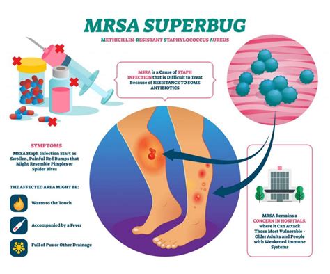 Mrsa And Infants