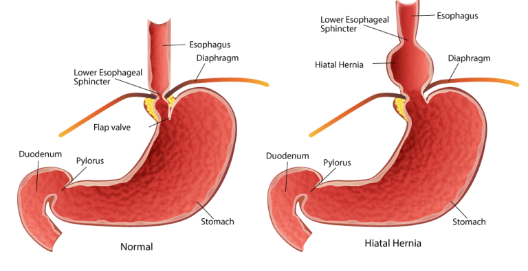 Mthfr And Digestion Healing The Hiatal Hernia Beyond Mthfr