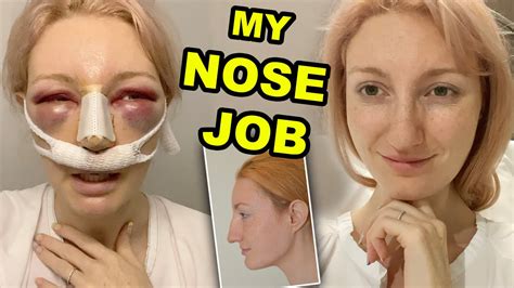 My Nose Job Part 1 Rhinoplasty Septoplasty Surgery Recovery