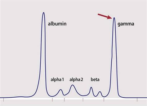 Myeloma Protein Multiple Myeloma Protein Test In Blood Urine