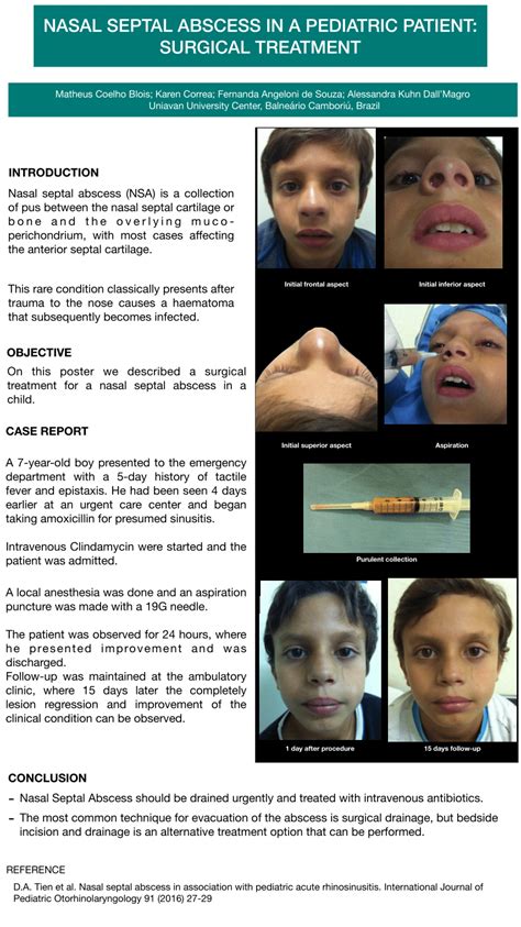 Nasal Abscess Treatment