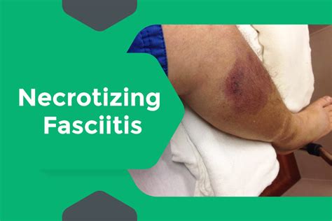 Necrotizing Fasciitis Selfcare