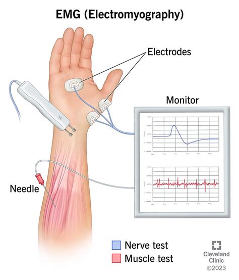 Nerve Conduction Guide: Accurate Emg Results