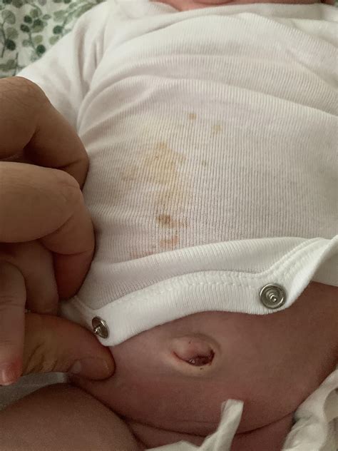 Newborn Belly Button Red: Reduce Infection Risk