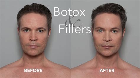 Non Surgical Botox Amp Filler Injections For Men Cheeks Chin Amp Forehead