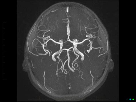 Normal Mr Angiogram Demonstrating Normal Arteries Of The Brain Known