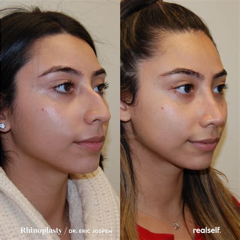 Nose Job Recovery Time Arie Sowers