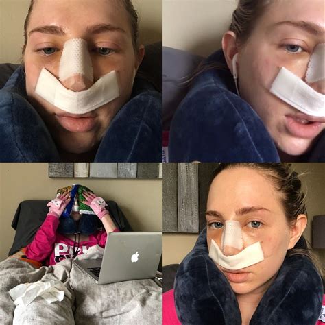 Nose Job Surgery Recovery Cast Removal Amp Two Week Post Op Reveal