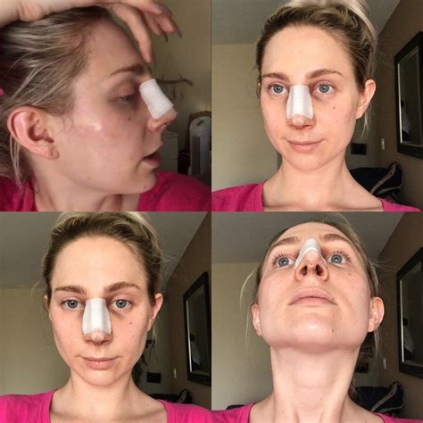 Nose Job Surgery Recovery Cast Removal Two Week Post Op Reveal