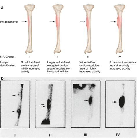 Nuclear Medicine Imaging Of Lower Leg Injuries Radiology Key