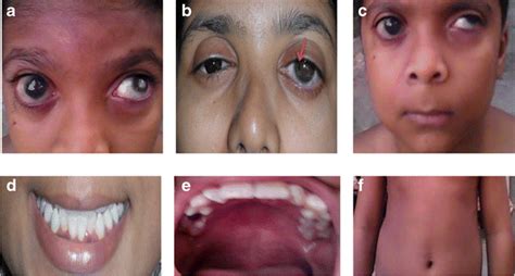 Ocular And Systemic Characteristics Of The Family With Axenfeld Rieger