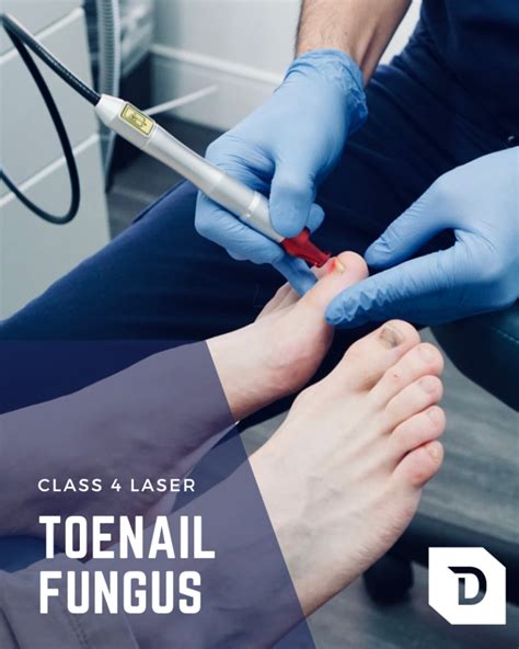 Onychomycosis Treatment Toenail Fungus Specialist Va, 60% Off