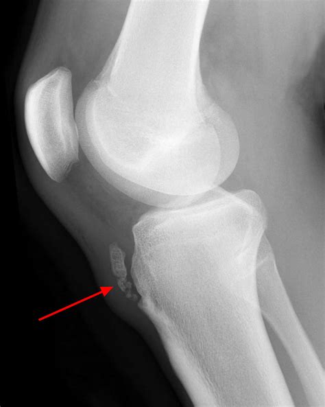 Osgood Schlatter S Disease