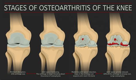 Osteoarthritis Causes Symptoms Diagnosis Prognosis Treatment