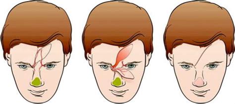 Paramedian Forehead Flap