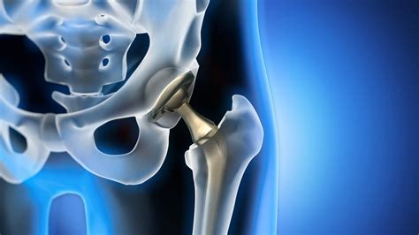 Partial Hip Replacement: Restore Mobility Today