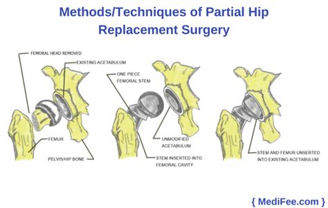 Partial Hip Replacement Surgery Methods Risks Precautions