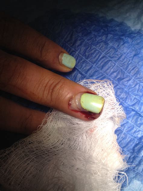 Partial Nail Avulsion Nail Ftempo