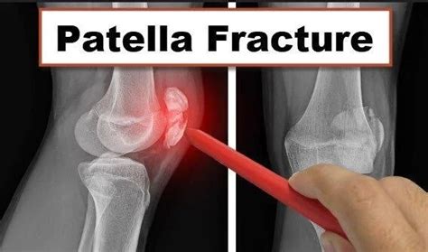 Patella Fracture Causes Types Symptoms Diagnosis Treatment Amp Recovery