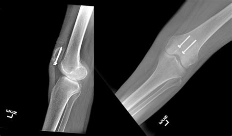 Patella Fractures Statpearls Ncbi Bookshelf