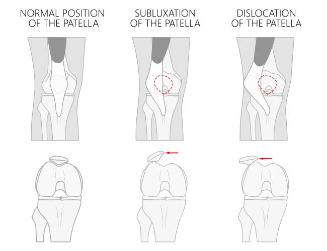 Patella Tracking Disorder