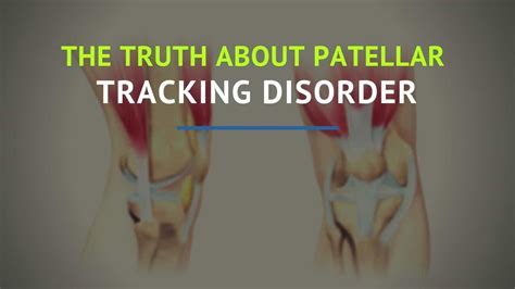 Patellar Tracking Disorder: Relieve Knee Pain