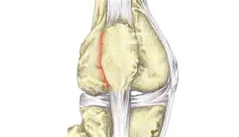 Patellofemoral Pain Syndrome Sportsinjuryclinic Net