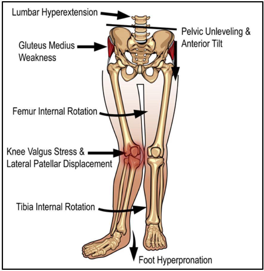 Patellofemoral Pain Syndrome Stretching Pregnant Health Tips