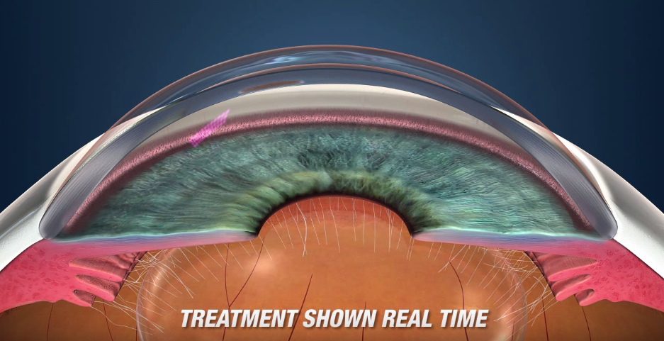 Pattern Scanning Laser Trabeculoplasty Pslt Treatment For Glaucoma